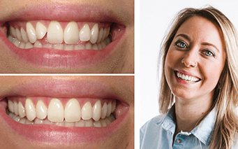 Before and after Invisalign smile example
