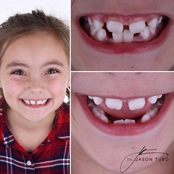 Real patient's smile before and after fluoride treatment
