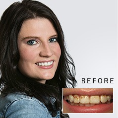 Woman grinning before and after treatment from Whitinsville dentist