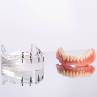 Clear base with several dental implants on reflective surface next to complete set of dentures