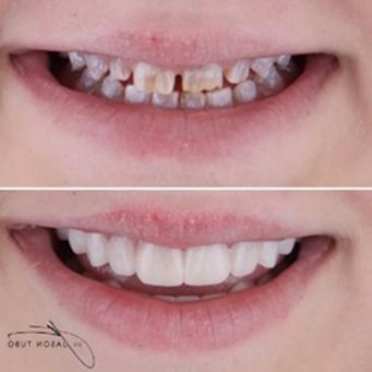 Closeup of patient's smile before and after porcelain veneers
