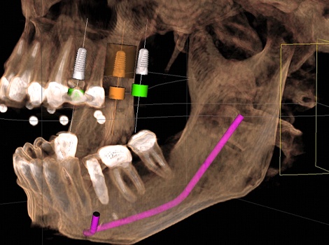 CBCT scan