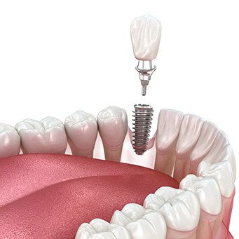 Illustration of a single dental implant