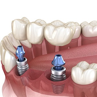 Illustration of an implant bridge