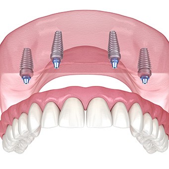 Illustration of an implant denture