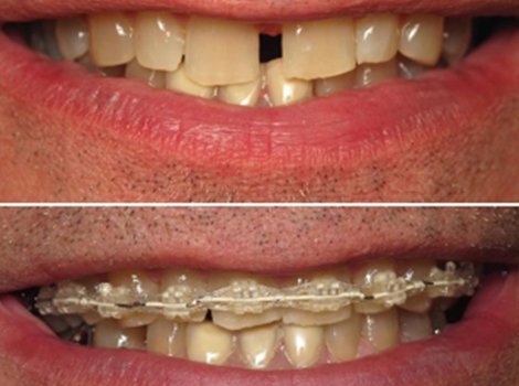 Closeup of smile before and during orthodontic treatment