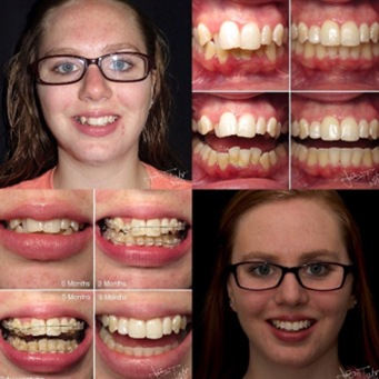 Images of patient's smile througout the six month smiles process