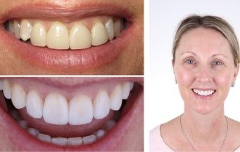 Before and after porcelain veneers