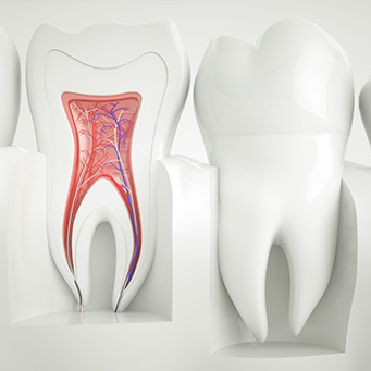 Animation of the inside of the tooth