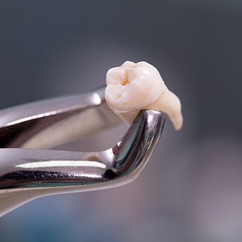 Metal clasp holding extracted tooth