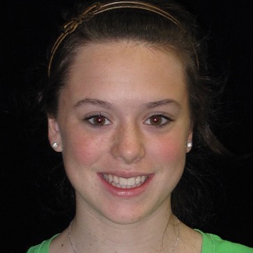 Samantha after Clear Aligner Therapy