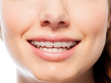 Closeup of a woman smiling with Six Month Smiles