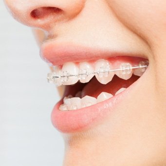 Closeup side angle of a woman with clear braces