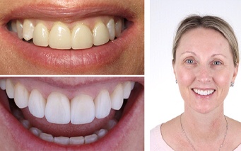 Porcelain veneers before and after