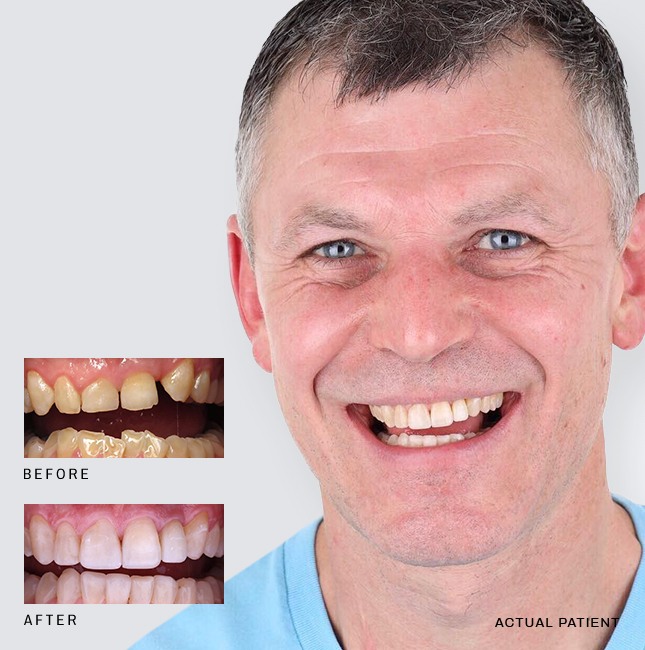 Older man smiling after dental treatment in Whitinsville