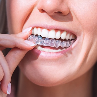 Patient placing clear aligners on top teeth