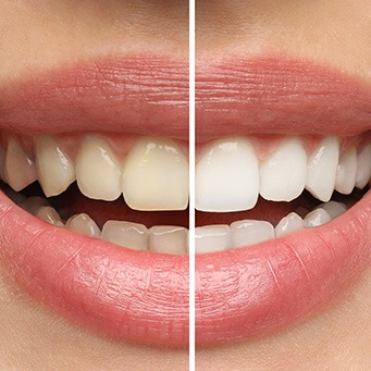 Closeup of patient's smile before and after teeth whitening