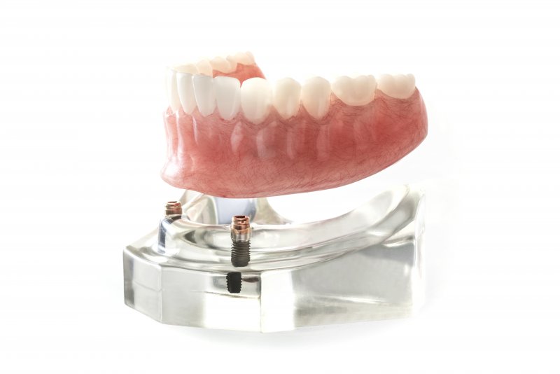 Close-up of a model of an implant denture