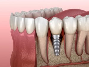 3D illustration of dental implants