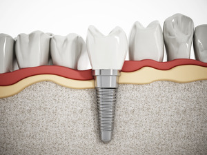 Illustration of a single dental implant in the jaw