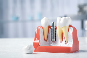 Dental implants offer many benefits, but can you still get them even if you already have a traditional denture or bridge? 