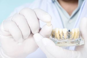 Dentist holding sample dental implant with gloved hands