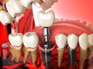 Model of a dental implant for single tooth replacement